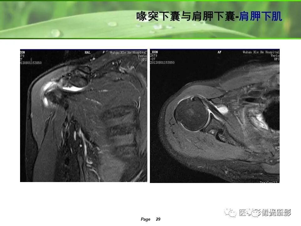 肩关节MRI解剖肩袖损伤诊断技巧--对应动图，效果超赞