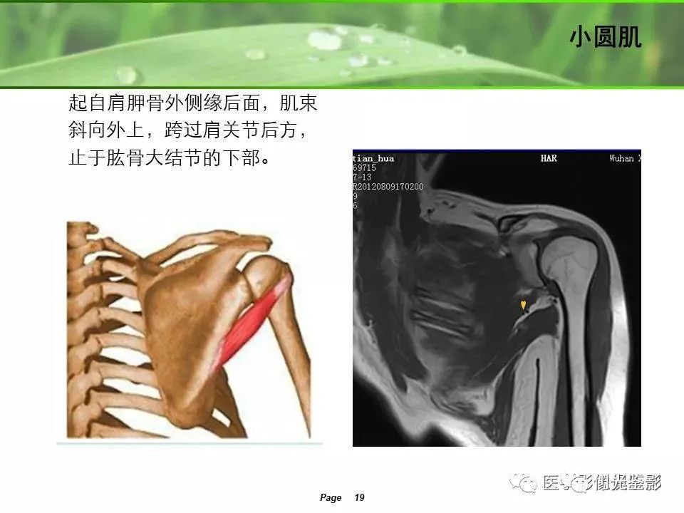 肩关节MRI解剖肩袖损伤诊断技巧--对应动图，效果超赞