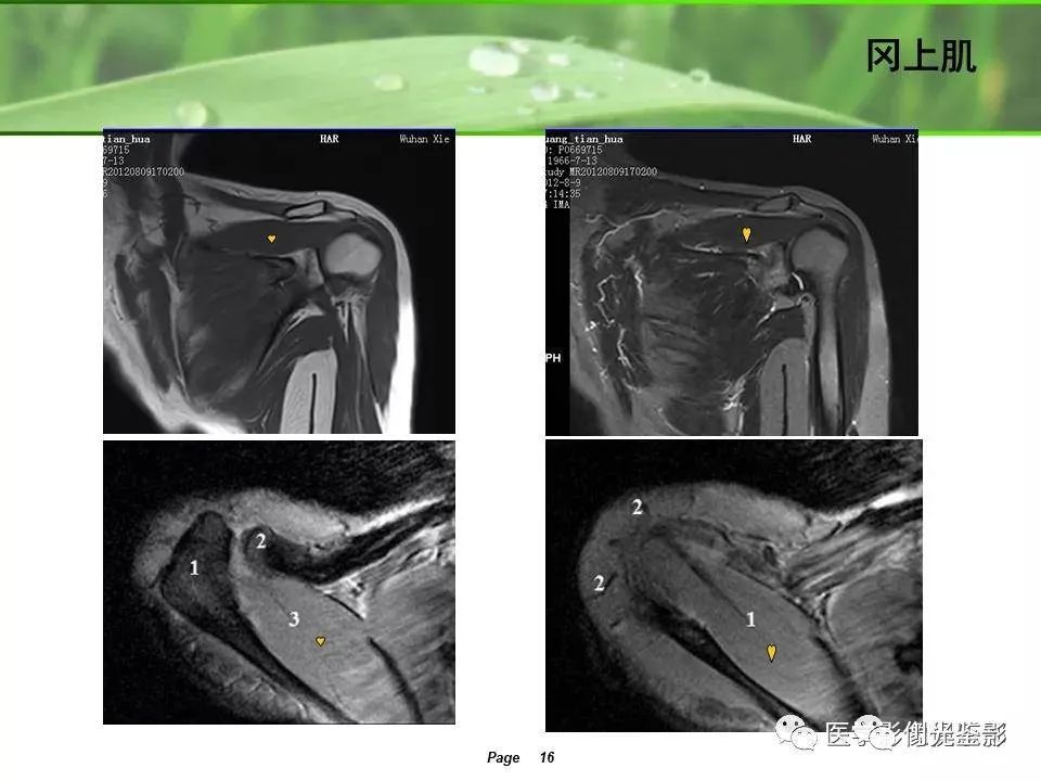 肩关节MRI解剖肩袖损伤诊断技巧--对应动图，效果超赞