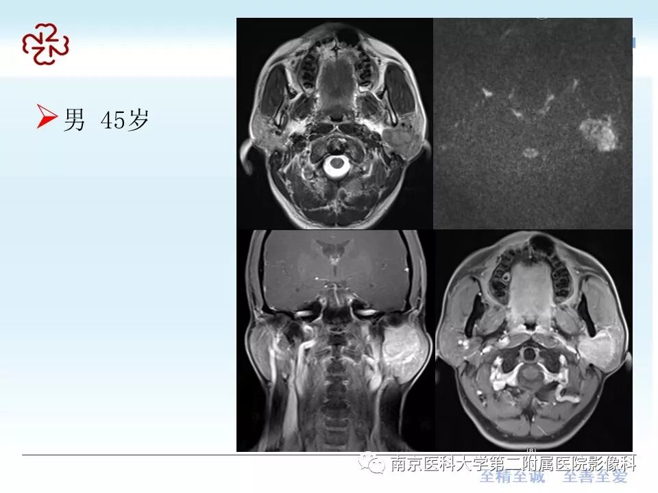 腮腺腺淋巴瘤的影像学表现