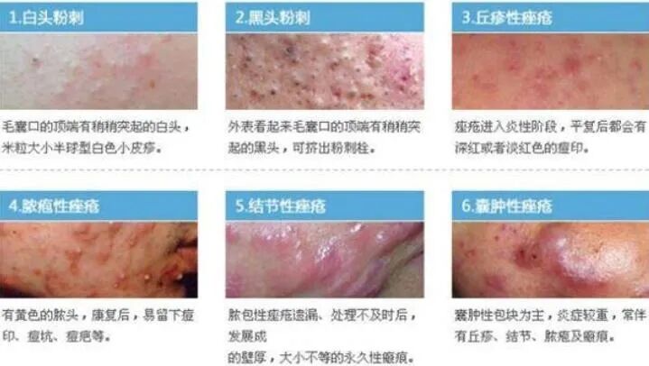 6张毛囊炎图片对比大全-女性毛囊炎初期图片，普及毛囊炎知识