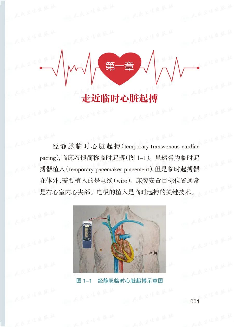 床旁心电图怎么做预售 ｜ 床旁临时心脏起搏手册，手把手教会起搏技术！_https://www.jmylbn.com_新闻资讯_第15张