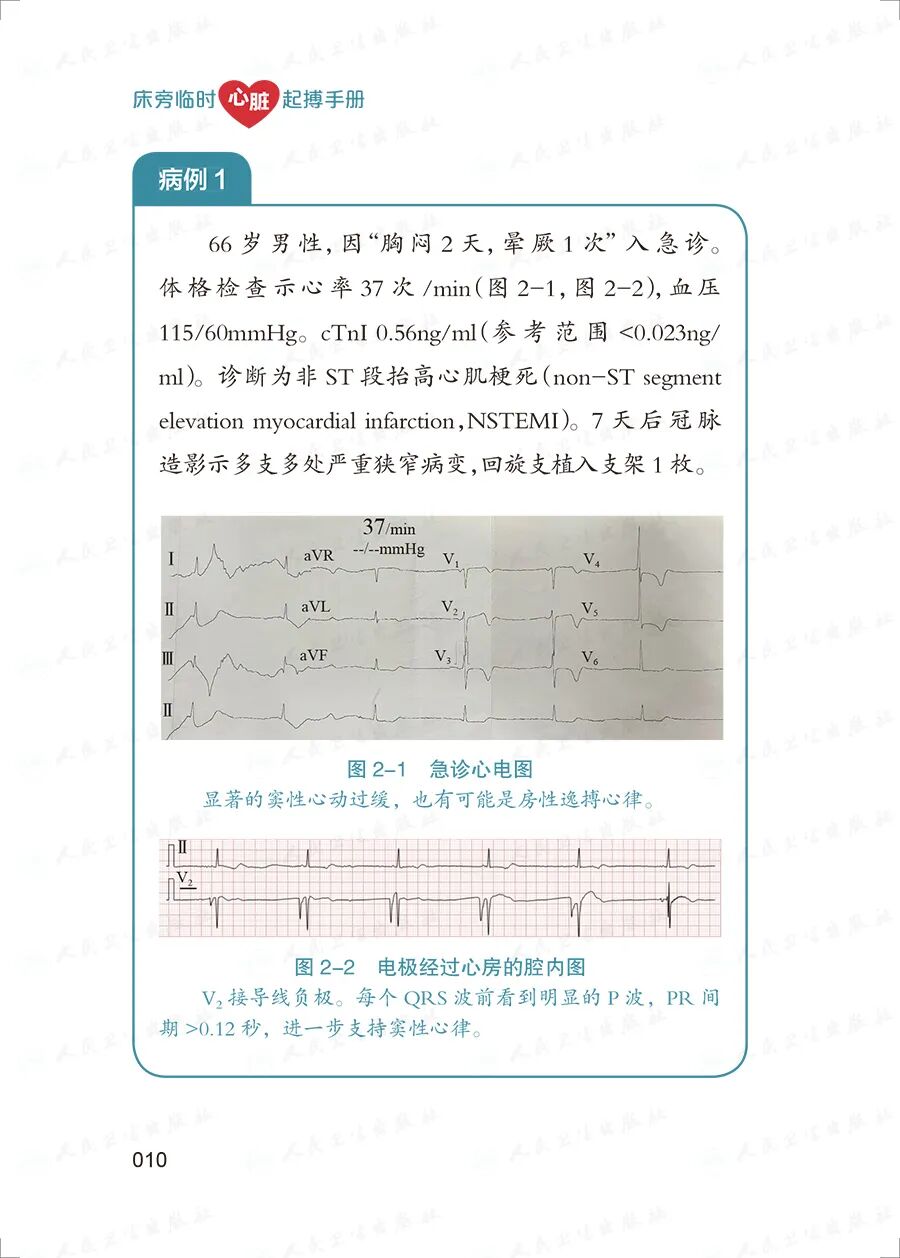 床旁心电图怎么做预售 ｜ 床旁临时心脏起搏手册，手把手教会起搏技术！_https://www.jmylbn.com_新闻资讯_第24张