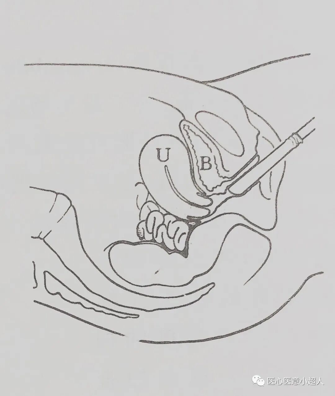 彩超探头怎么消毒妇科彩超探测的途径与方法_https://www.jmylbn.com_新闻资讯_第4张