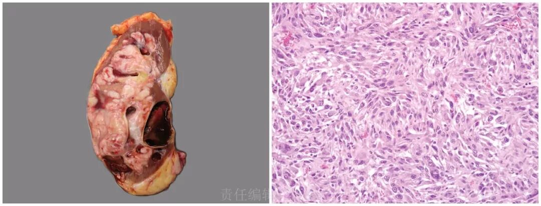 fh染色是什么意思遗传性平滑肌瘤病和肾细胞癌综合征（一）_https://www.jmylbn.com_新闻资讯_第8张