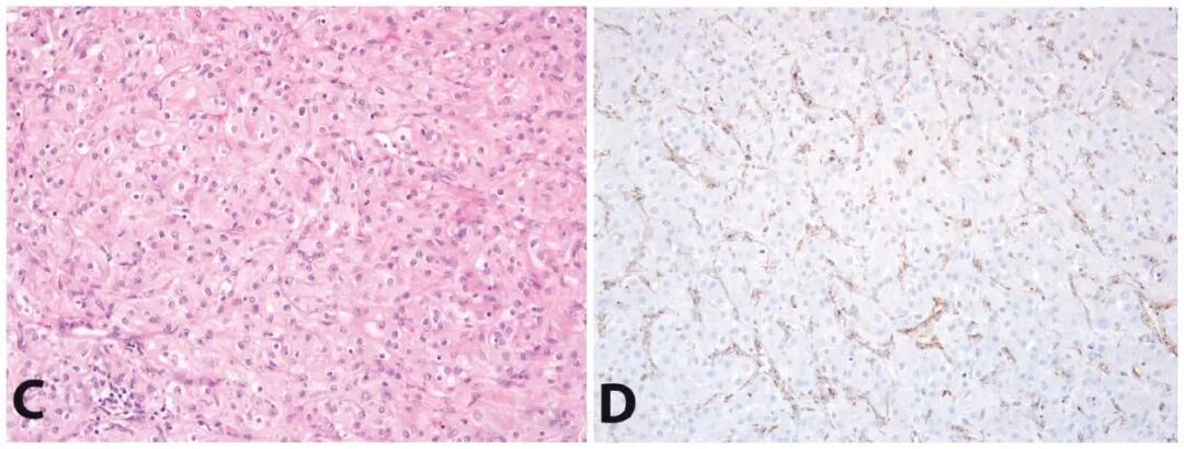 fh染色是什么意思遗传性平滑肌瘤病和肾细胞癌综合征（一）_https://www.jmylbn.com_新闻资讯_第11张