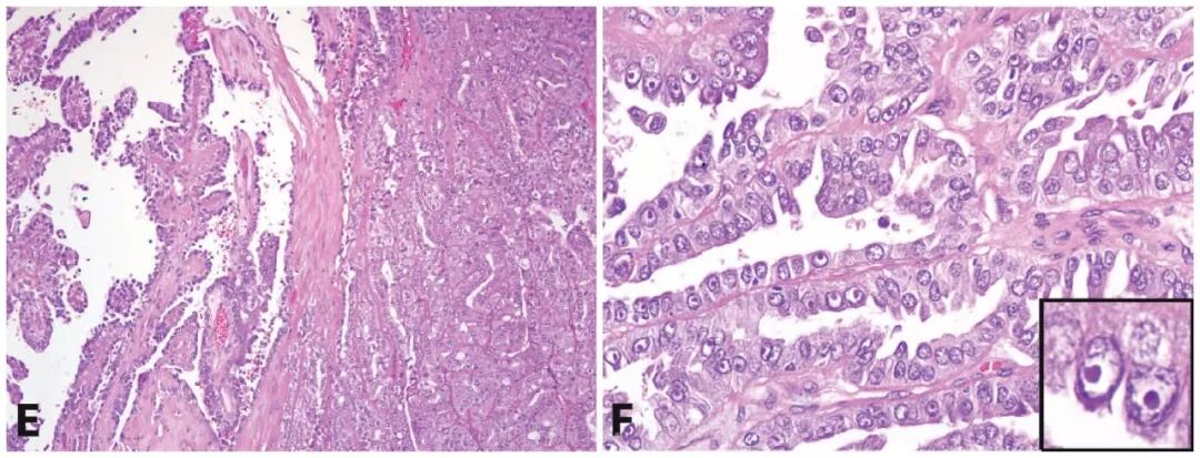 fh染色是什么意思遗传性平滑肌瘤病和肾细胞癌综合征（一）_https://www.jmylbn.com_新闻资讯_第4张