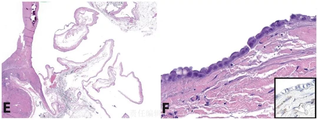 fh染色是什么意思遗传性平滑肌瘤病和肾细胞癌综合征（一）_https://www.jmylbn.com_新闻资讯_第12张