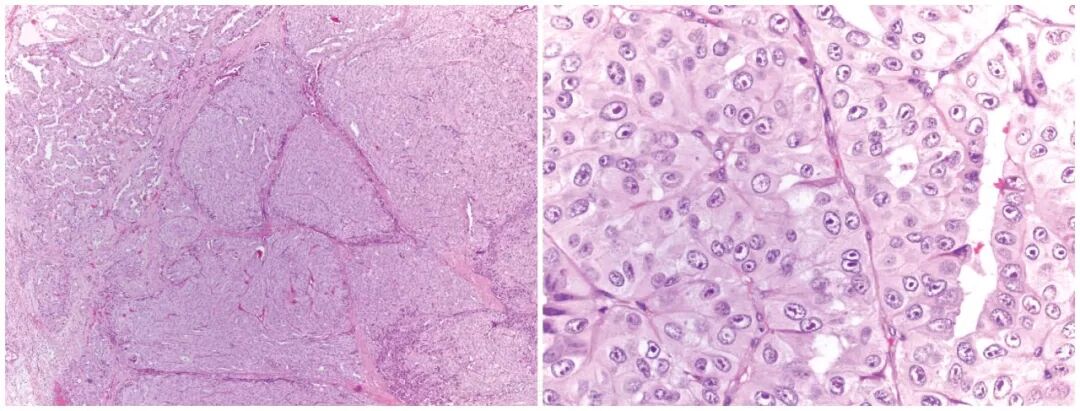 fh染色是什么意思遗传性平滑肌瘤病和肾细胞癌综合征（一）_https://www.jmylbn.com_新闻资讯_第6张