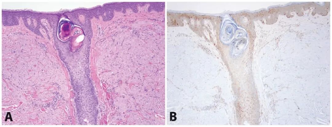 fh染色是什么意思遗传性平滑肌瘤病和肾细胞癌综合征（一）_https://www.jmylbn.com_新闻资讯_第2张