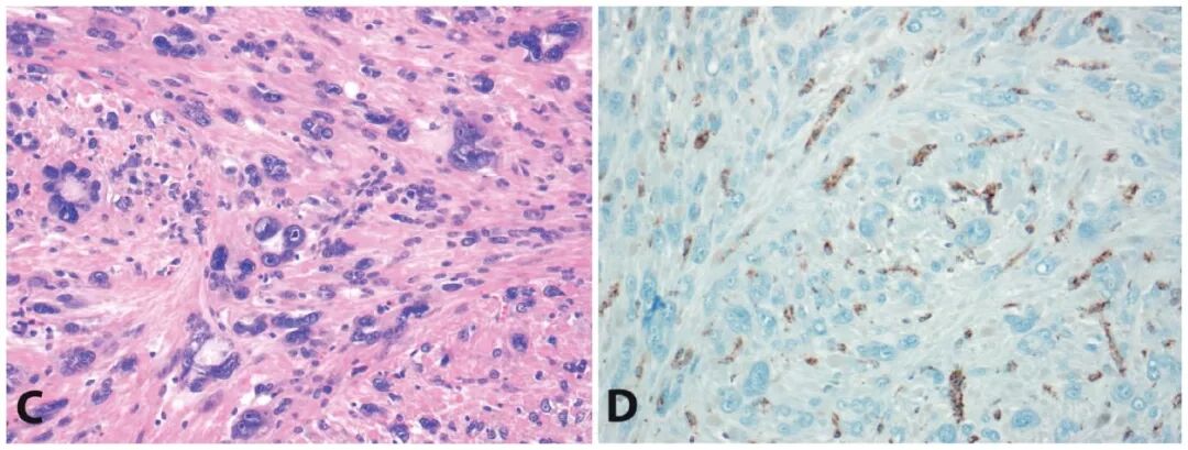 fh染色是什么意思遗传性平滑肌瘤病和肾细胞癌综合征（一）_https://www.jmylbn.com_新闻资讯_第3张