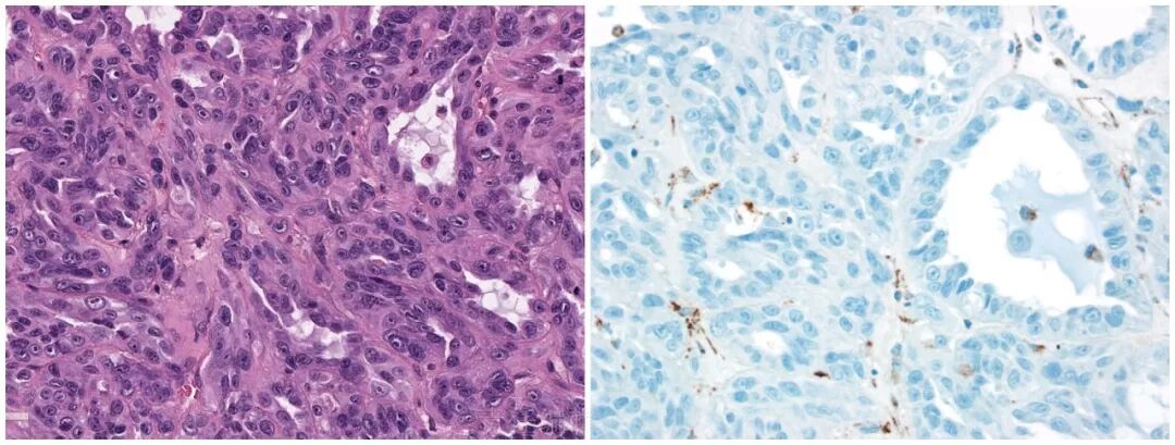 fh染色是什么意思遗传性平滑肌瘤病和肾细胞癌综合征（一）_https://www.jmylbn.com_新闻资讯_第7张