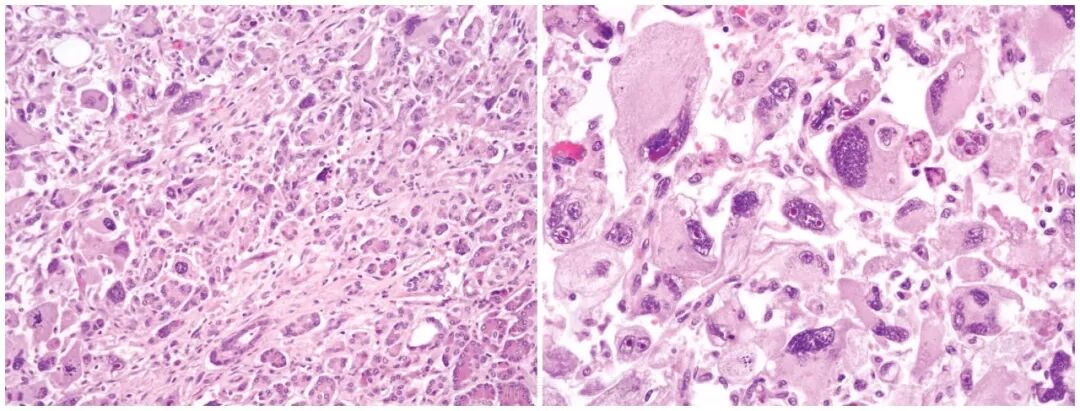 fh染色是什么意思遗传性平滑肌瘤病和肾细胞癌综合征（一）_https://www.jmylbn.com_新闻资讯_第9张