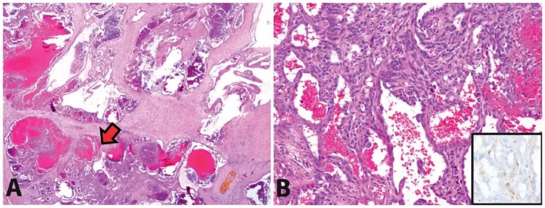 fh染色是什么意思遗传性平滑肌瘤病和肾细胞癌综合征（一）_https://www.jmylbn.com_新闻资讯_第10张
