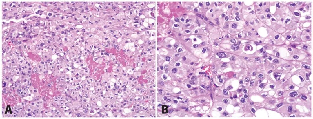 fh染色是什么意思遗传性平滑肌瘤病和肾细胞癌综合征（一）_https://www.jmylbn.com_新闻资讯_第5张