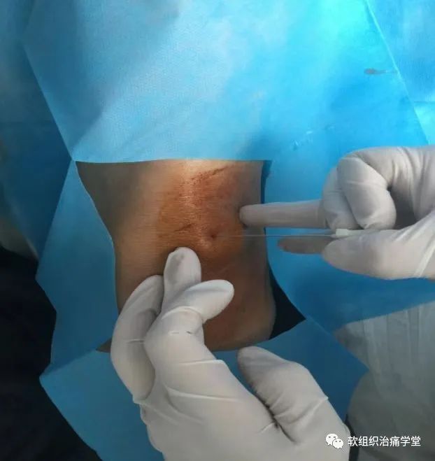 三例小针刀疗法医疗事故带来的思考