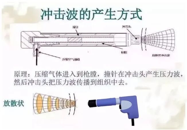 冲击波治疗效果怎么样体外冲击波治疗颈肩腰腿痛效果好_https://www.jmylbn.com_新闻资讯_第3张