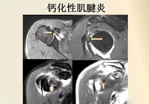 冲击波治疗效果怎么样体外冲击波治疗颈肩腰腿痛效果好_https://www.jmylbn.com_新闻资讯_第6张