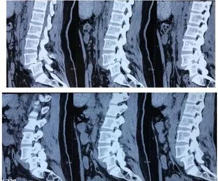 冲击波治疗效果怎么样体外冲击波治疗颈肩腰腿痛效果好_https://www.jmylbn.com_新闻资讯_第7张
