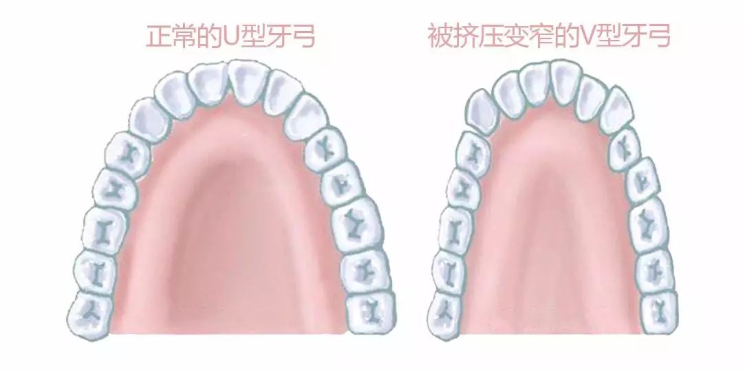 長期用嘴呼吸的女生，最後都是這個下場！ 健康 第13張