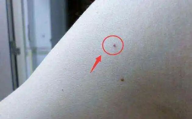 古法经络|血痣，肝胆病变前兆！