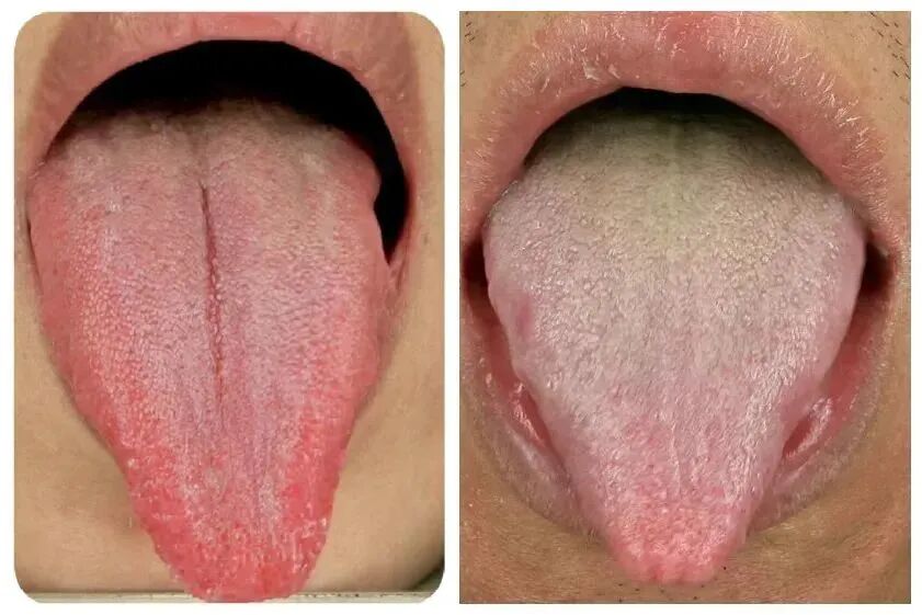 您是否需要中成药小柴胡颗粒？舌头的形状会告诉你防疫系列文字复习