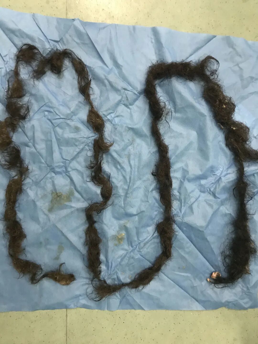 畸胎瘤|【惊呆】女子腹中取出2米多长头发！工作38年的医生：从来没见过