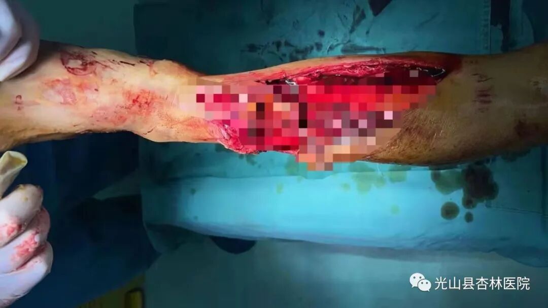 为什么负压引流浅谈VSD技术（负压封闭引流术）_https://www.jmylbn.com_新闻资讯_第3张