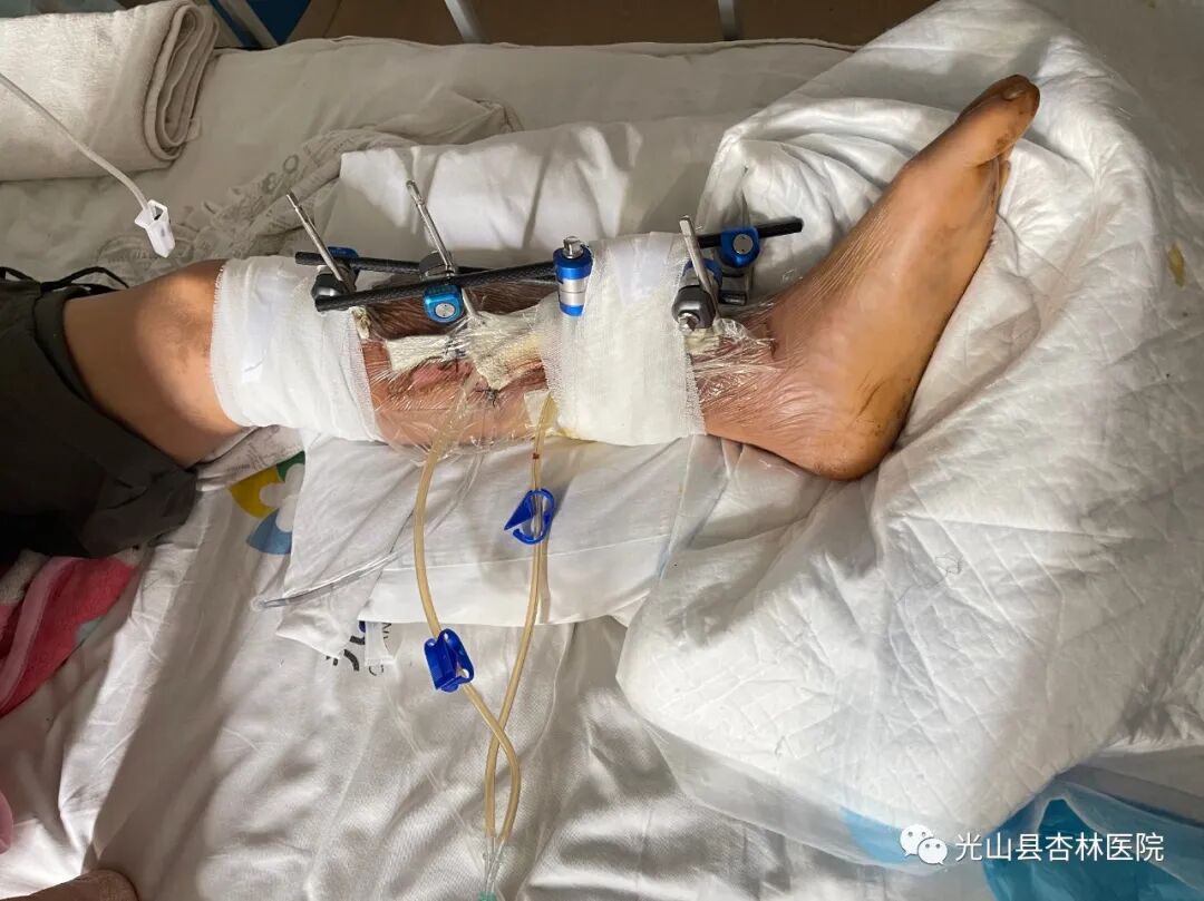 为什么负压引流浅谈VSD技术（负压封闭引流术）_https://www.jmylbn.com_新闻资讯_第5张