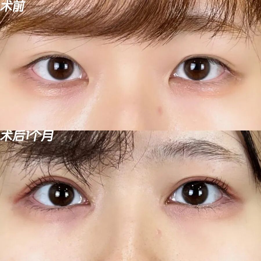 开眼角手术一般需要多少钱