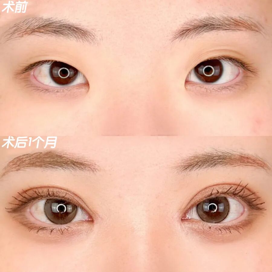 开眼角手术一般需要多少钱
