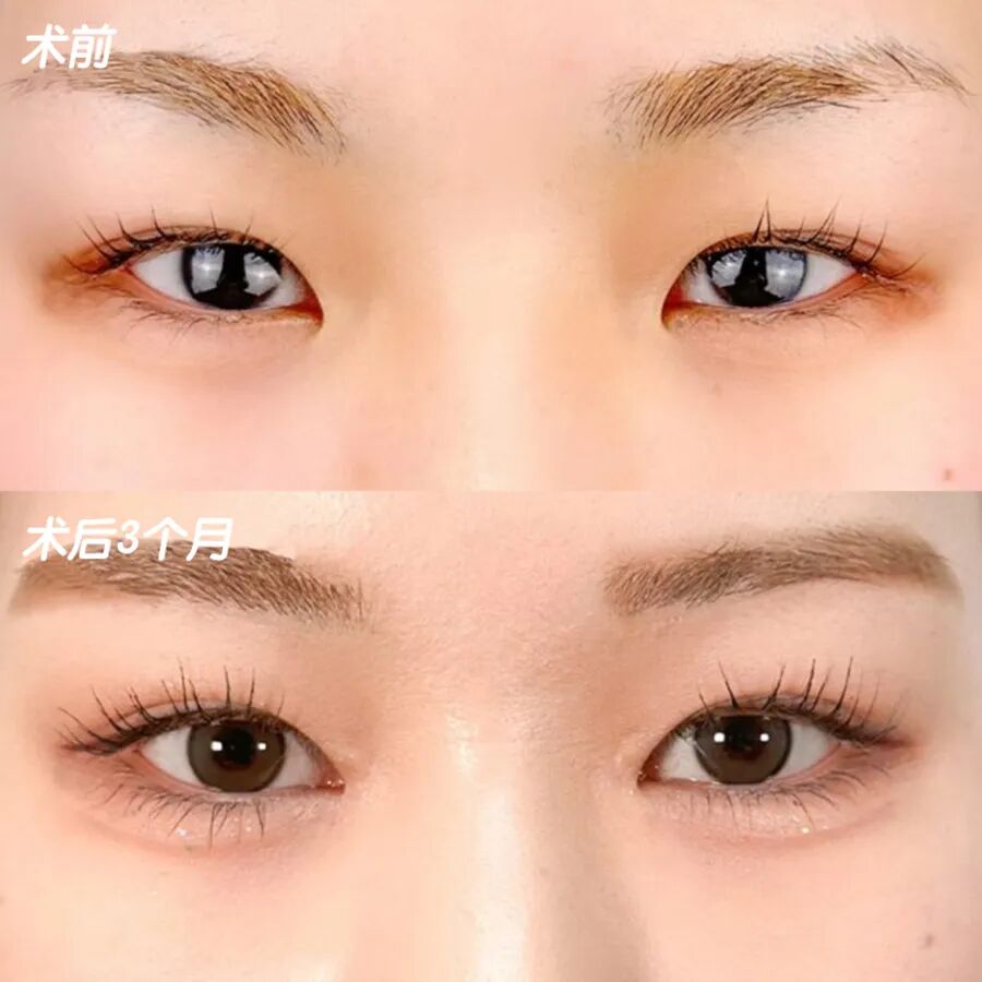 开眼角手术一般需要多少钱