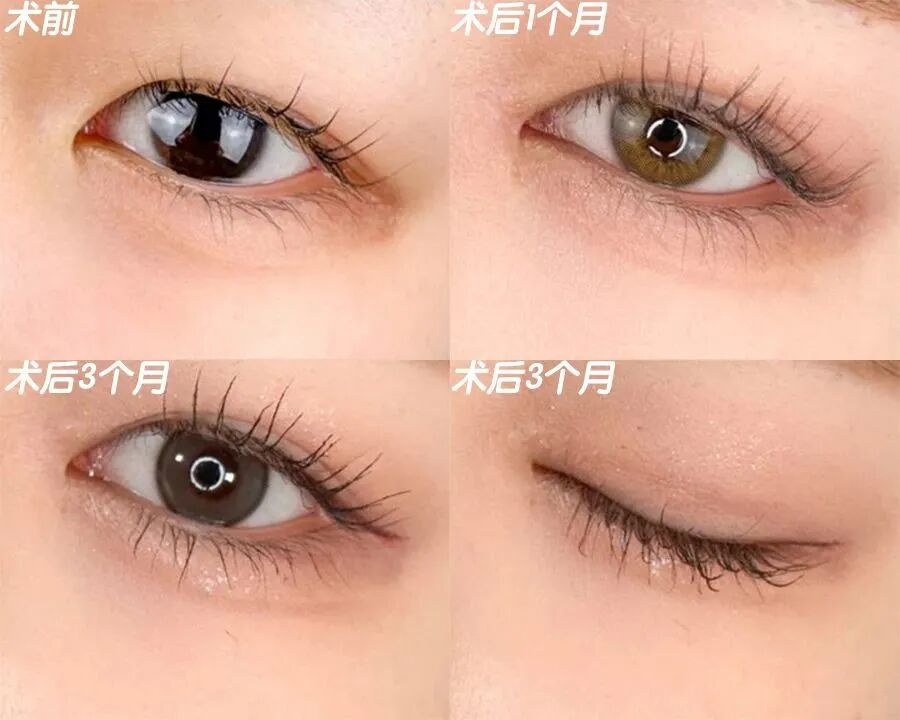 开眼角手术一般需要多少钱