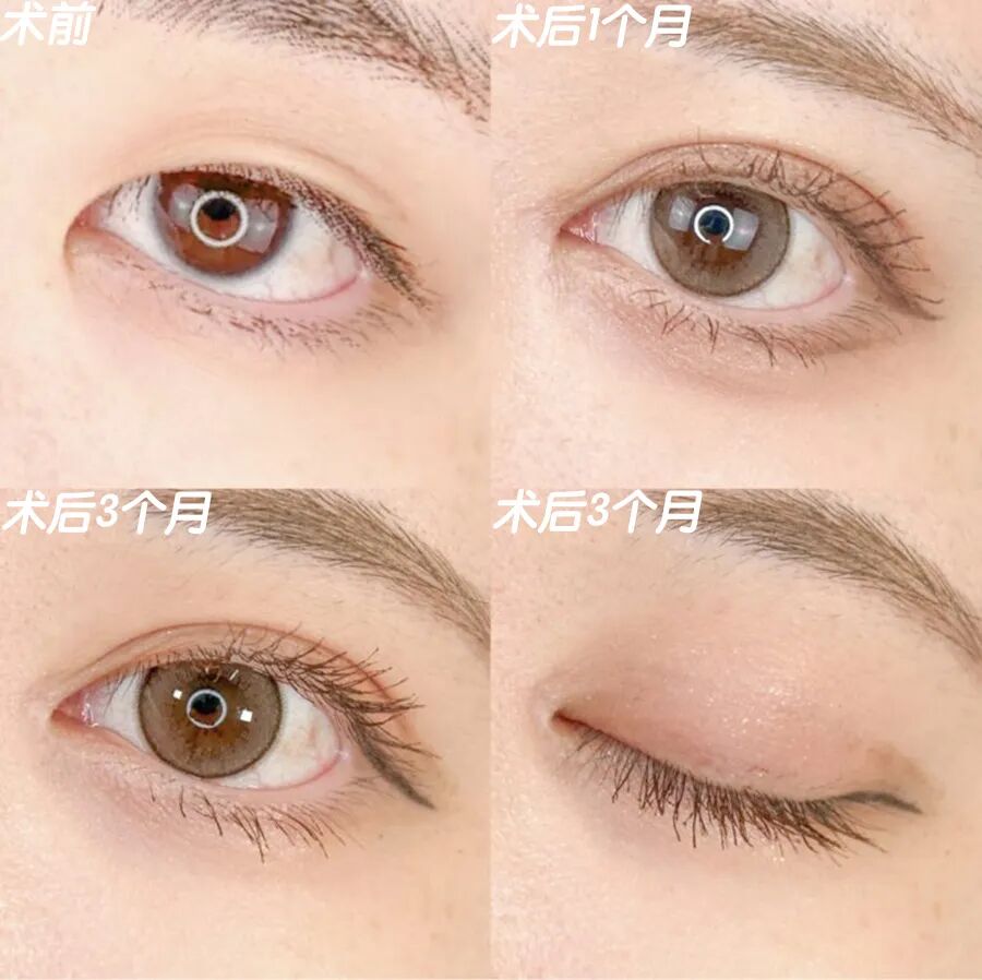 开眼角手术一般需要多少钱