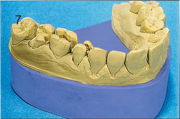 7,由於其邊緣穩定性高,成型樹脂精密吻合,完全適用於牙橋和牙冠8,任何