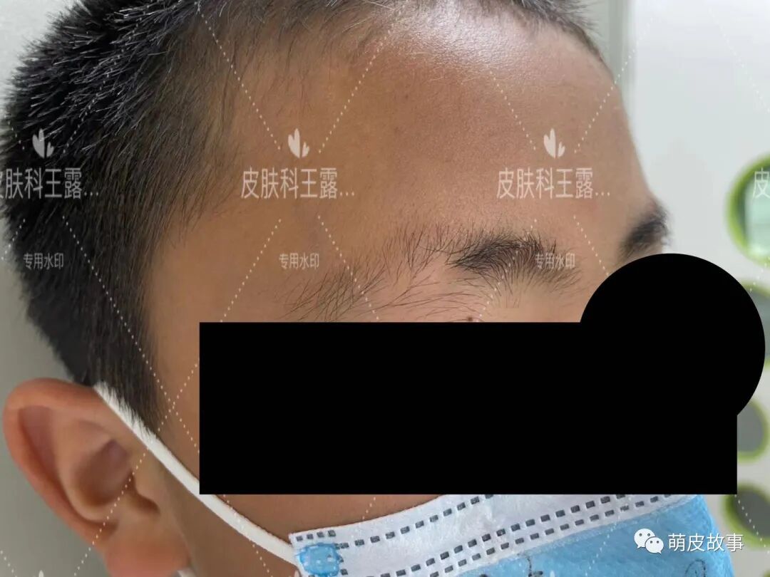 儿童脱发之拔毛癖~附典型病例