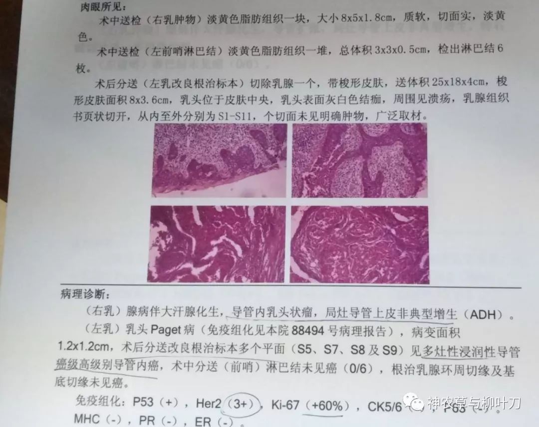 乳腺湿疹样癌图片