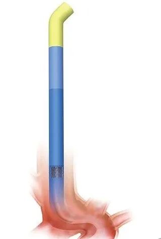 什么叫导引导管日问1715.《神介常识手册》第22期.什么是导引导管？_https://www.jmylbn.com_新闻资讯_第3张