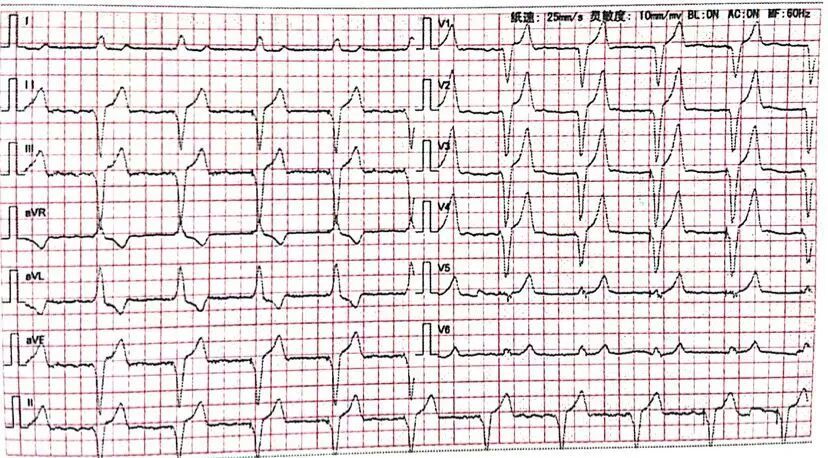 心电图器怎么用起搏器心电图不会看？靠这三步就够了！_https://www.jmylbn.com_新闻资讯_第5张