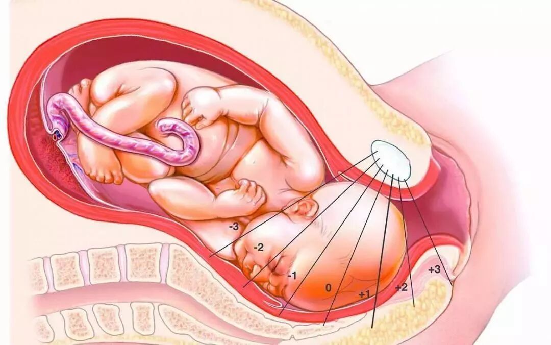 为什么剖腹产的孩子要进行感统训练？