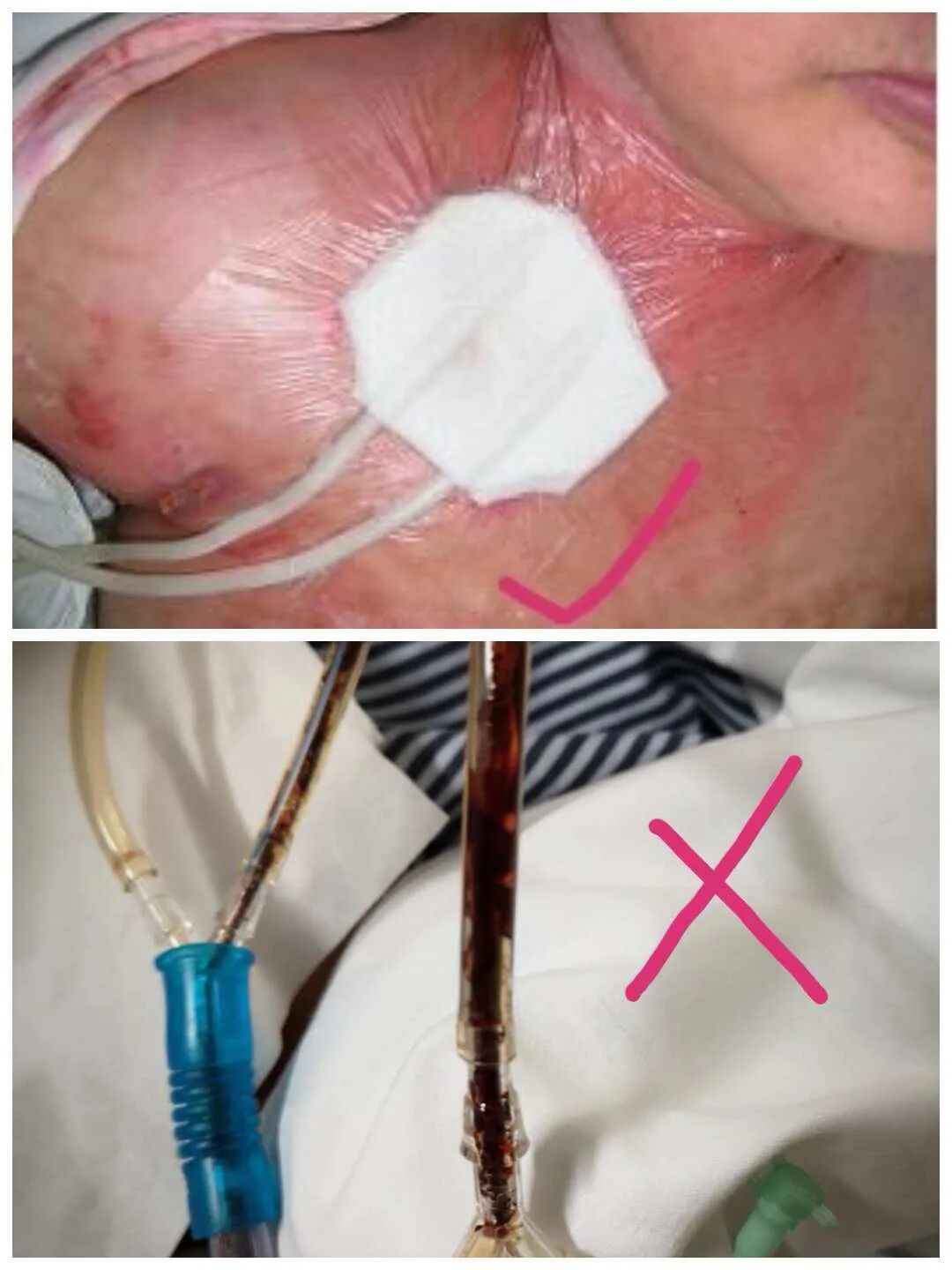 为什么负压引流一文读懂骨科常用的创面VSD（负压封闭引流）技术_https://www.jmylbn.com_新闻资讯_第33张