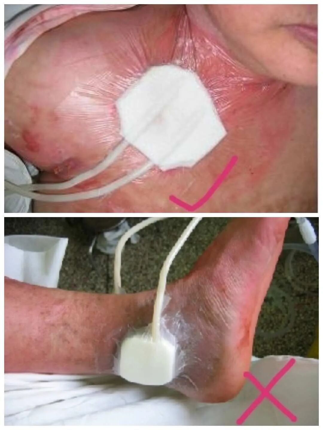 为什么负压引流一文读懂骨科常用的创面VSD（负压封闭引流）技术_https://www.jmylbn.com_新闻资讯_第32张