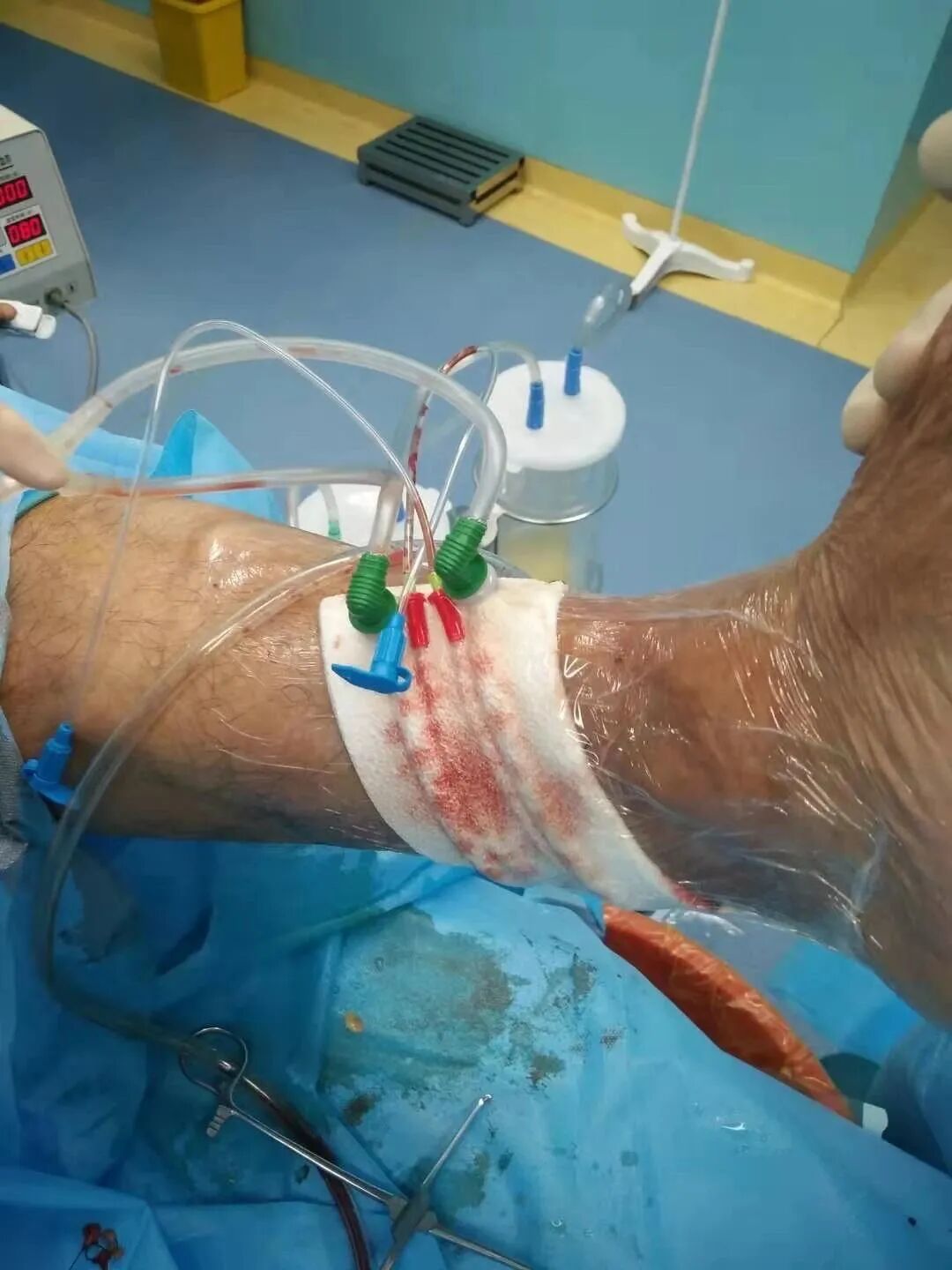 为什么负压引流一文读懂骨科常用的创面VSD（负压封闭引流）技术_https://www.jmylbn.com_新闻资讯_第28张