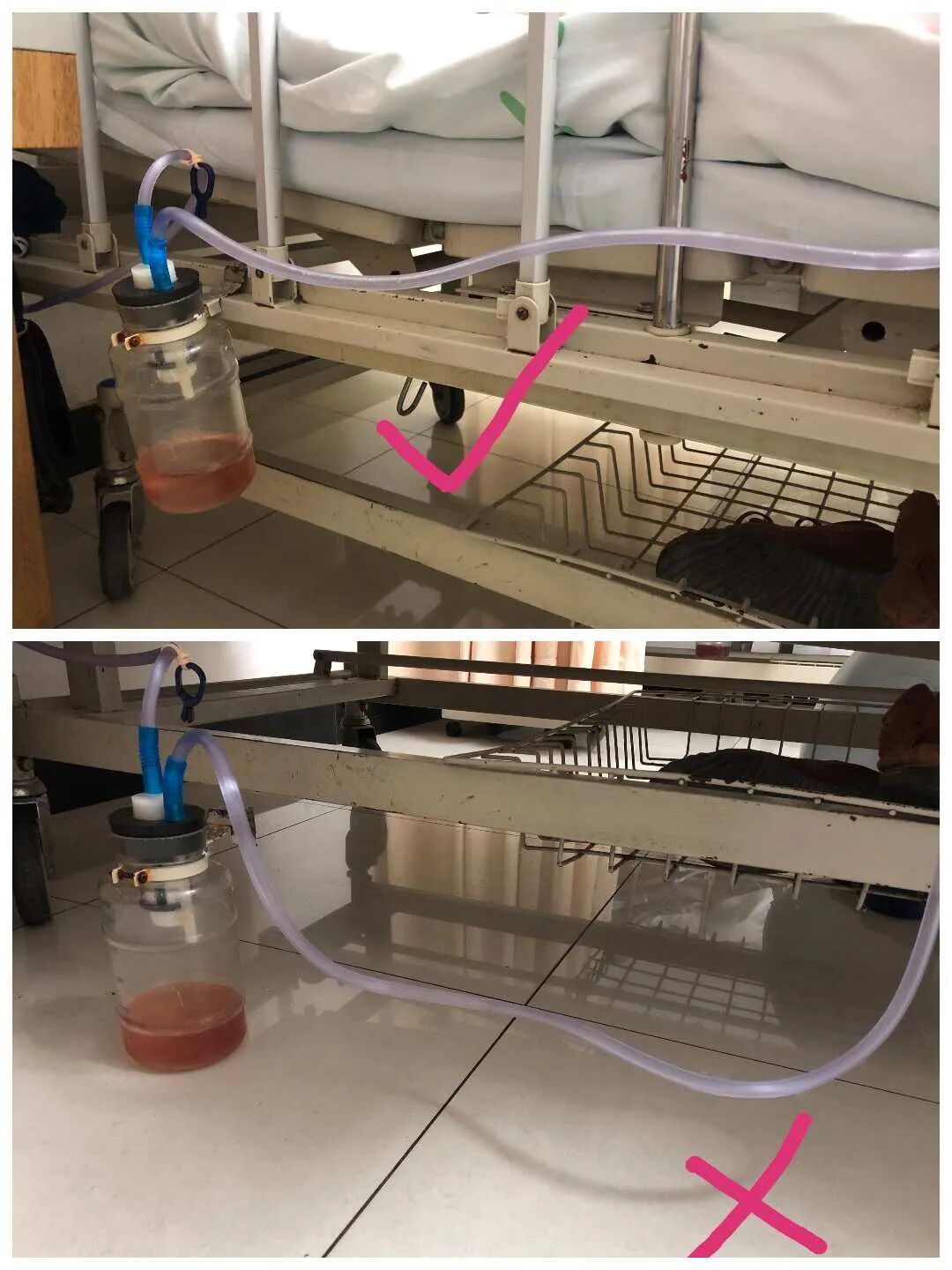 为什么负压引流一文读懂骨科常用的创面VSD（负压封闭引流）技术_https://www.jmylbn.com_新闻资讯_第31张