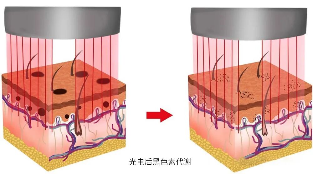 什么是光电治疗光电项目后为何会“反黑”？这些治疗方法超有效_https://www.jmylbn.com_新闻资讯_第5张