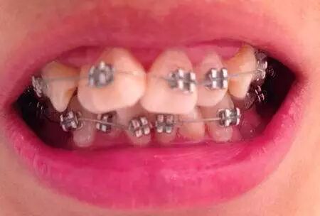 隐形矫正 让您的牙齿悄悄变美