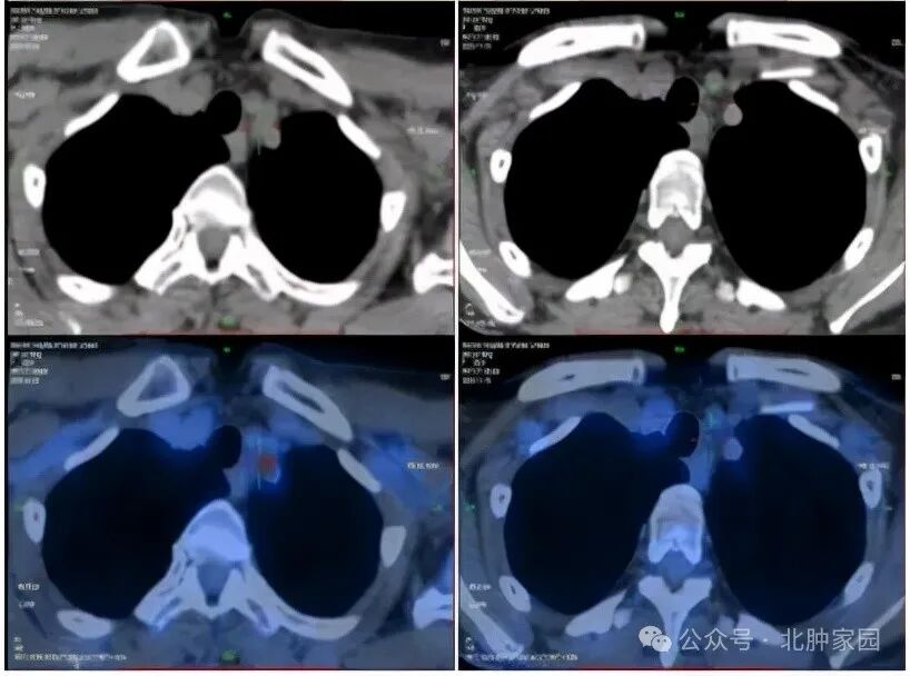 胰腺癌晚期肝转移：回家还是住院，如何抉择？