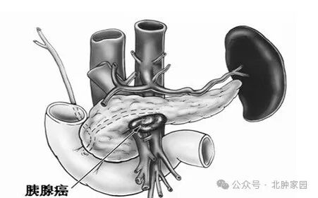 胰腺癌晚期怎么治疗最佳方案
