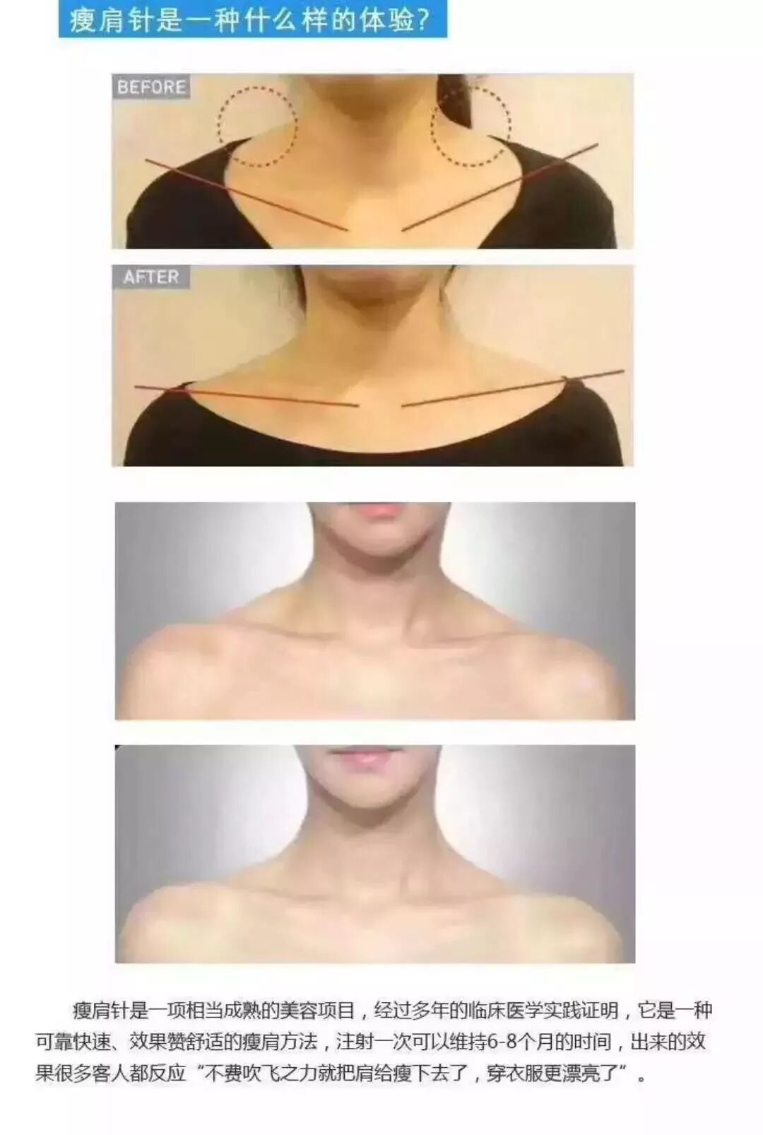 瘦肩针注射方法 内含操作视频 医美之家 微信公众号文章阅读 Wemp