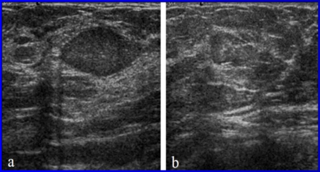 乳腺机为什么叫钼靶乳腺钼靶和乳腺彩超的区别_https://www.jmylbn.com_新闻资讯_第18张